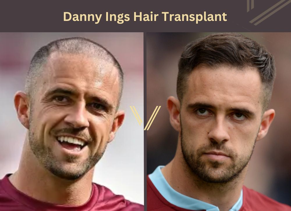 danny ings hair transplant before after