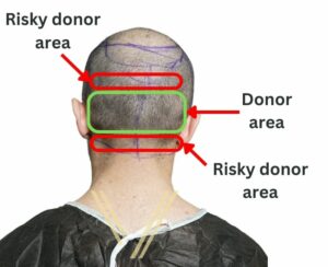 donor area for hair transplant candidate