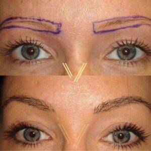 eyebrow transplant before after