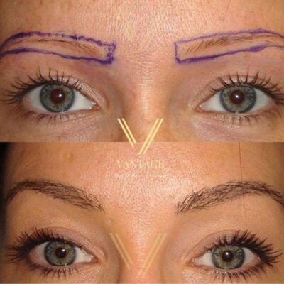 female eyebrow transplant before after