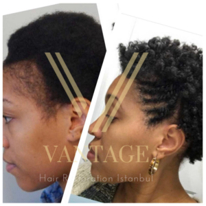 female afro hair transplant before after