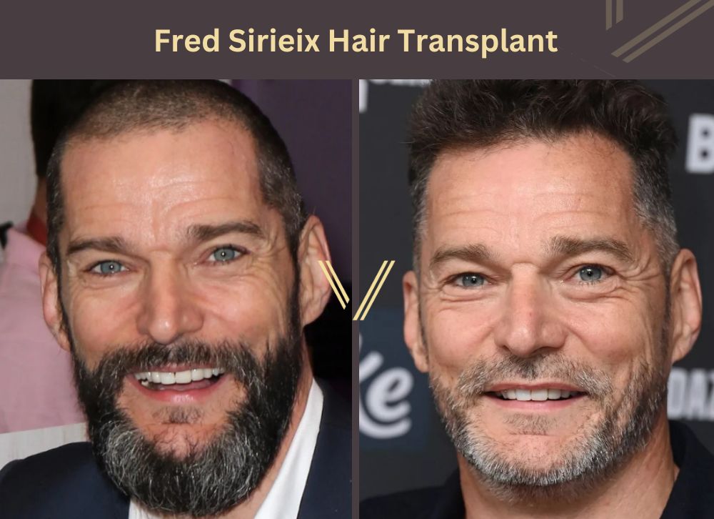 fred sirieix hair transplant before after
