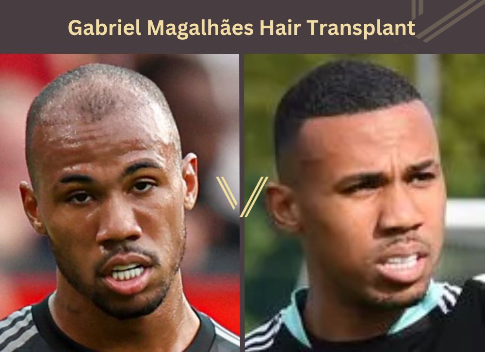 gabriel magalhães chunkz hair transplant before after