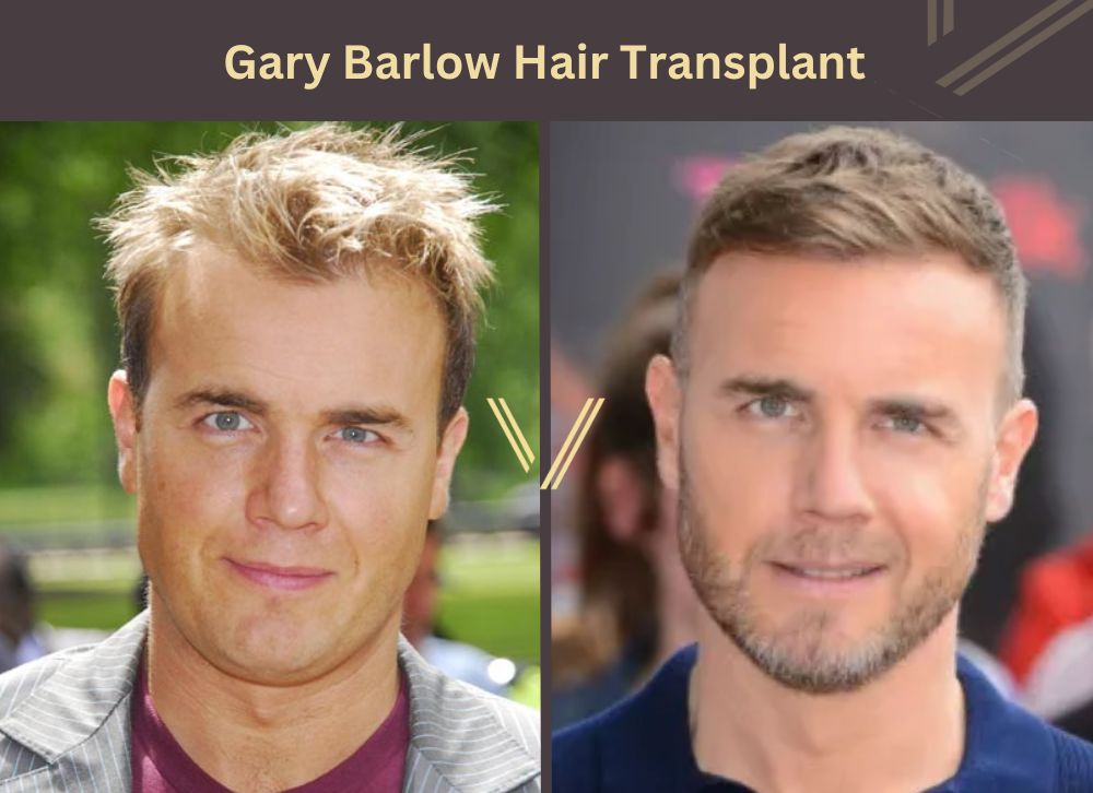 gary barlow hair transplant before after