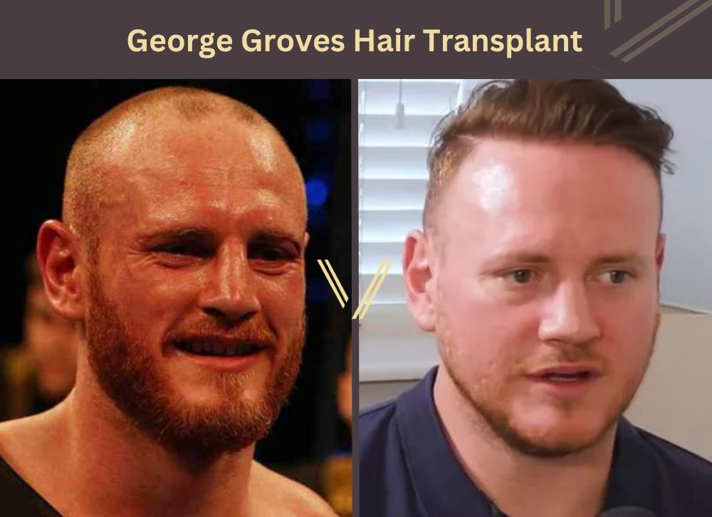 george groves hair transplant before after