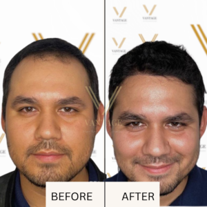 hair transplant candidacy before after