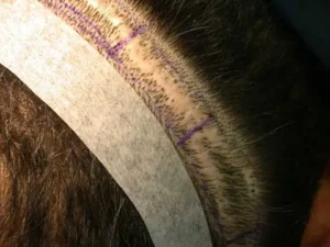hair transplant-scar-operation