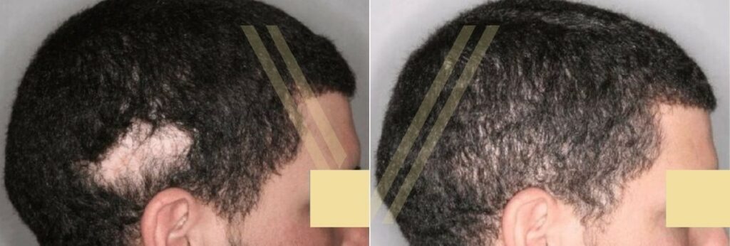 hair transplant scar revision before after
