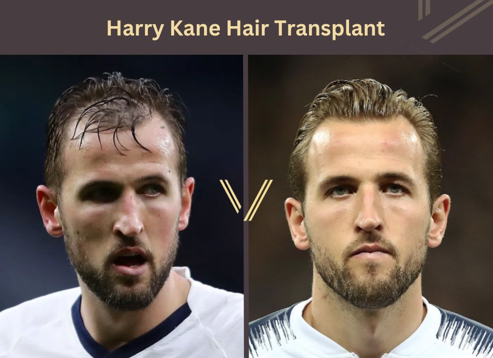 harry kane hair transplant before after
