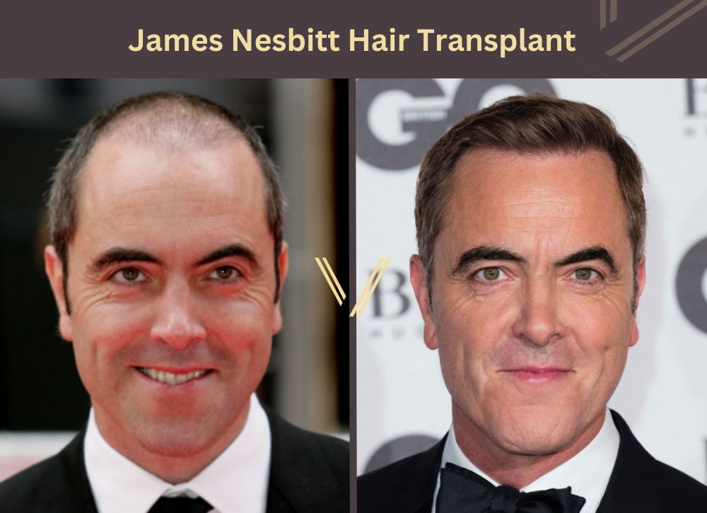 james nesbitt hair transplant before after