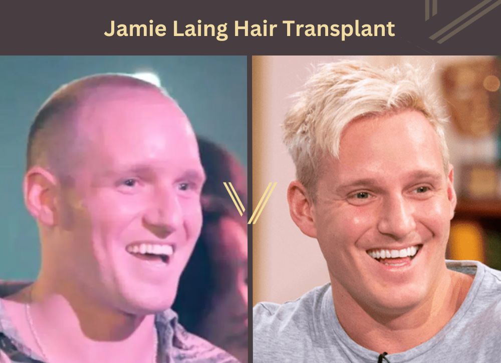 jamie laing hair transplant before after
