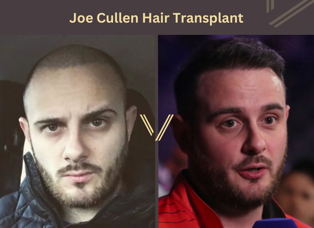 joe cullen hair transplant before after