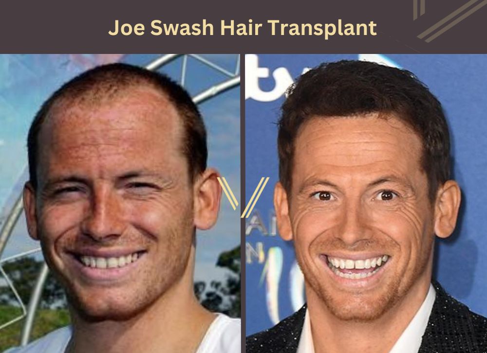 joe swash hair transplant before after