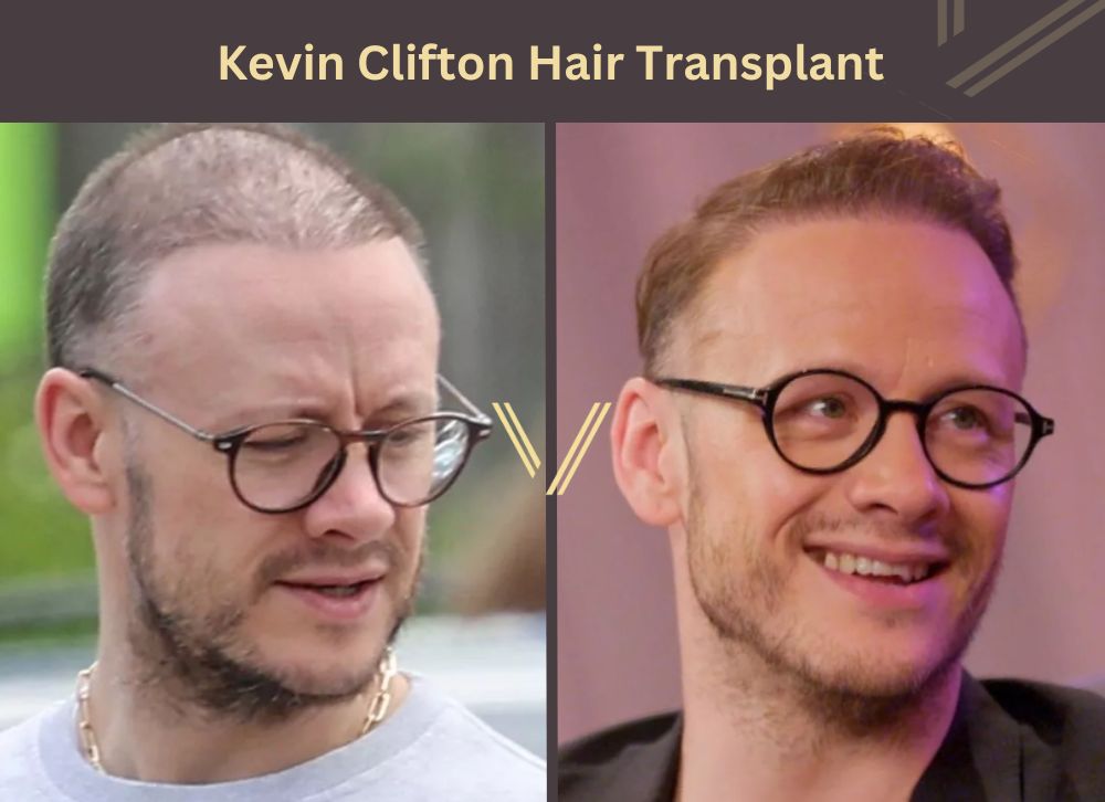 kevin clifton hair transplant before after
