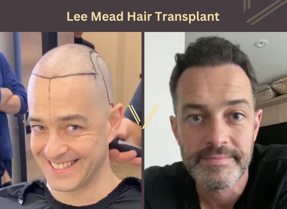 lee mead hair transplant before after