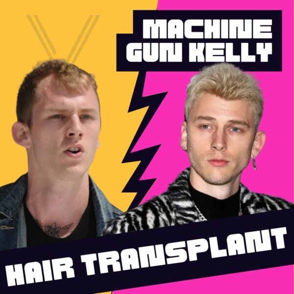 machine gun kelly hair transplant