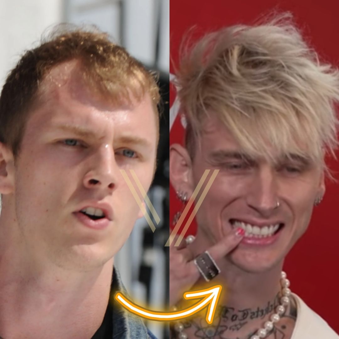 MGK's Hair Transplant Before and After Transformation