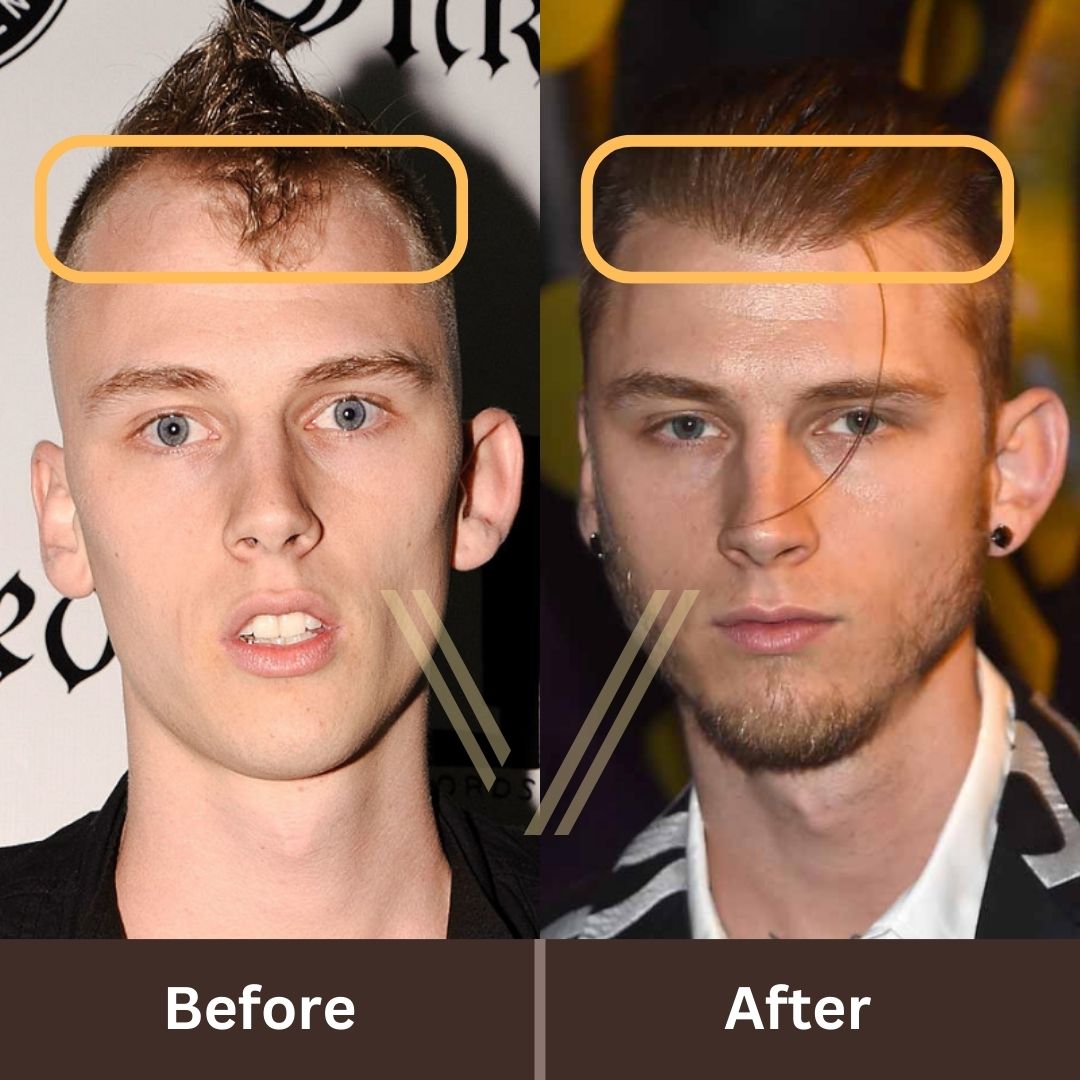 MGK