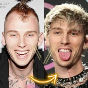 machine gun kelly hair transplant before and after result