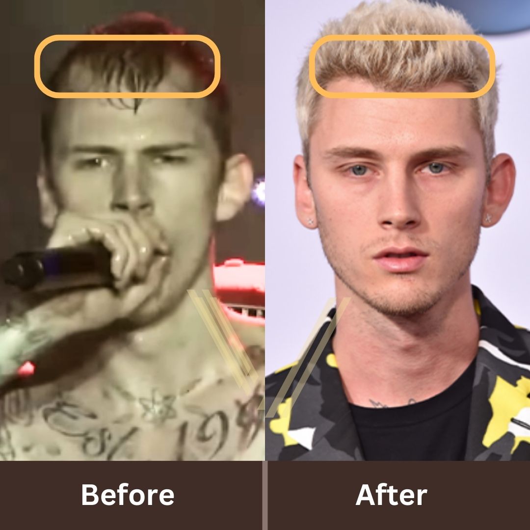 MGK's Hair Transplant Before and After Transformation