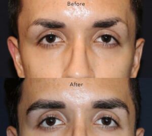 man eyebrow transplant before after