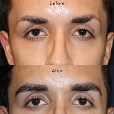 man eyebrow transplant before after