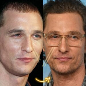 matthew mcconaughey hair transplant before and after 