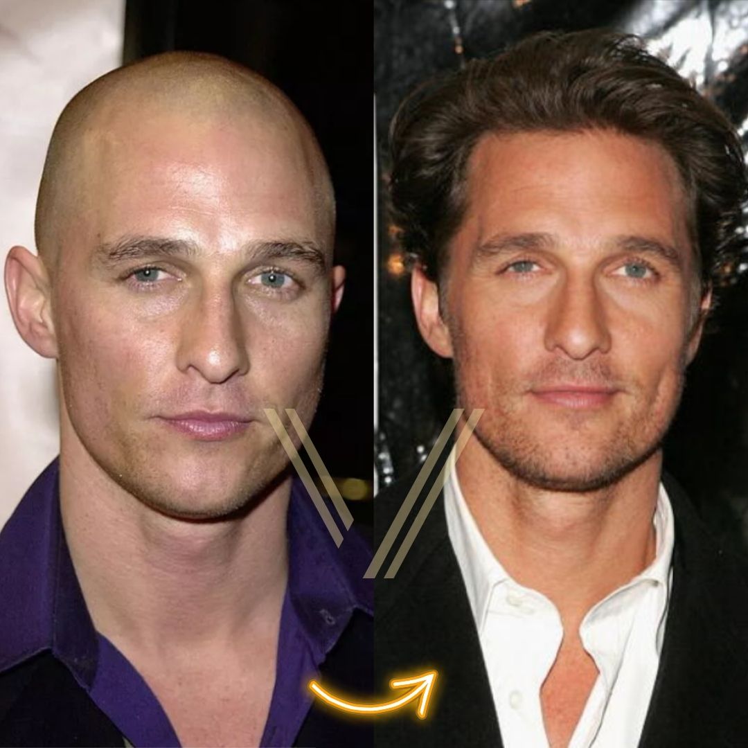 Matthew McConaughey Hair Transplant Before and After Result