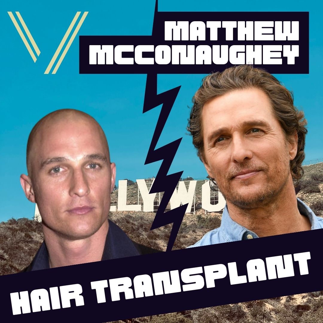 matthew mcconaughey hair transplant