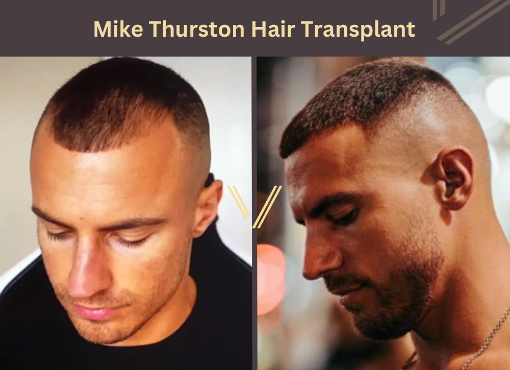 mike thurston hair transplant before after