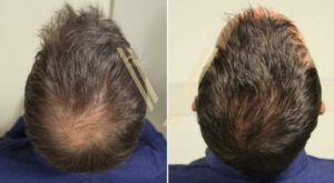 minoxidil hair transplant