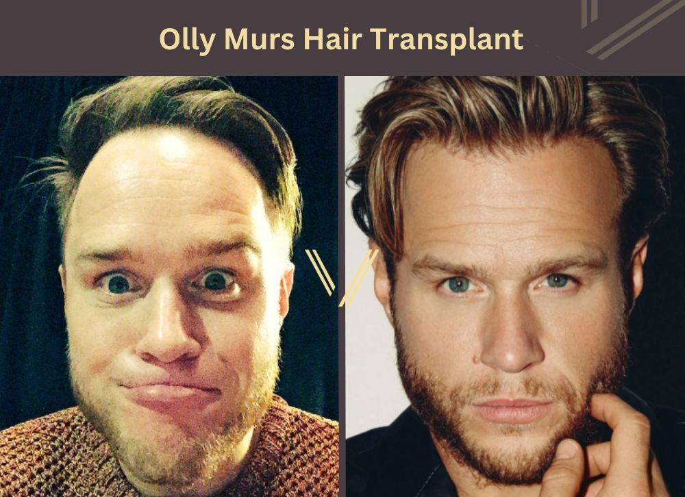 olly murs hair transplant before after