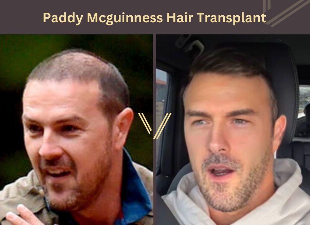 paddy mcguinness hair transplant before after