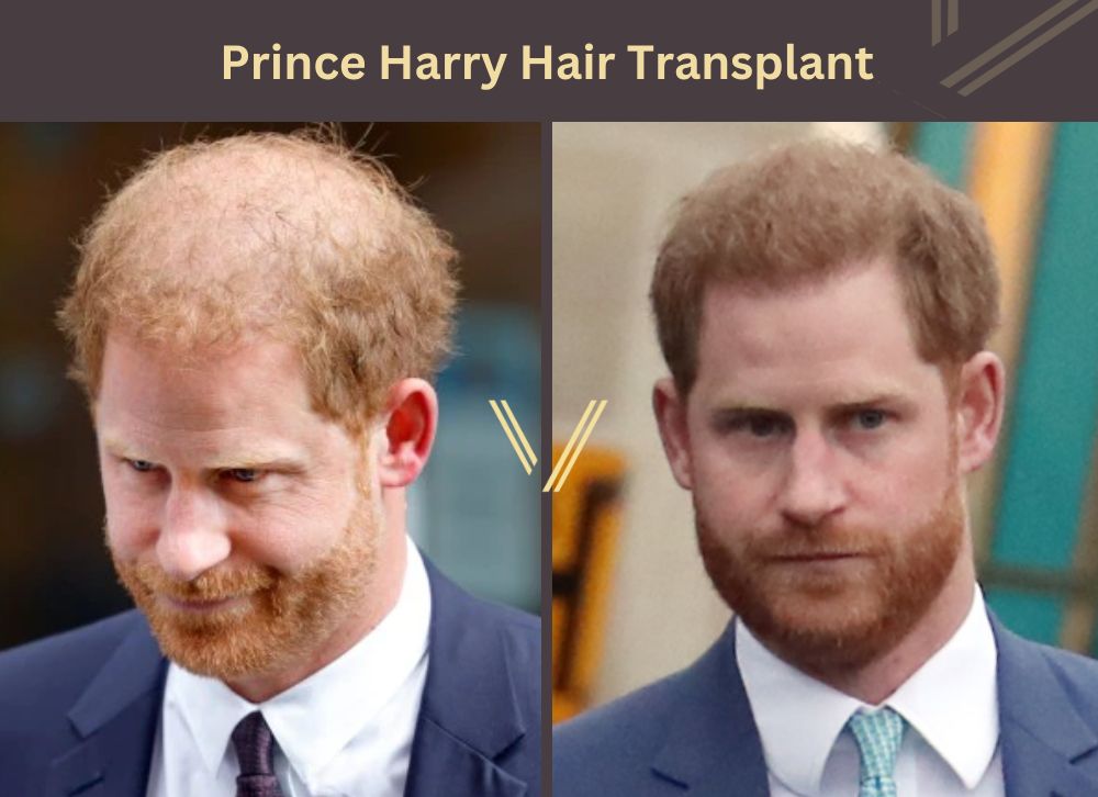 prince harry hair transplant before after