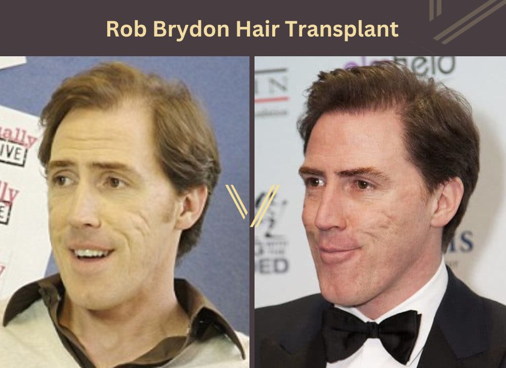 rob brydon hair transplant before after