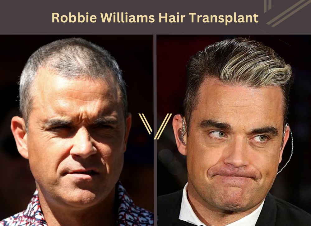 robbie williams hair transplant before after