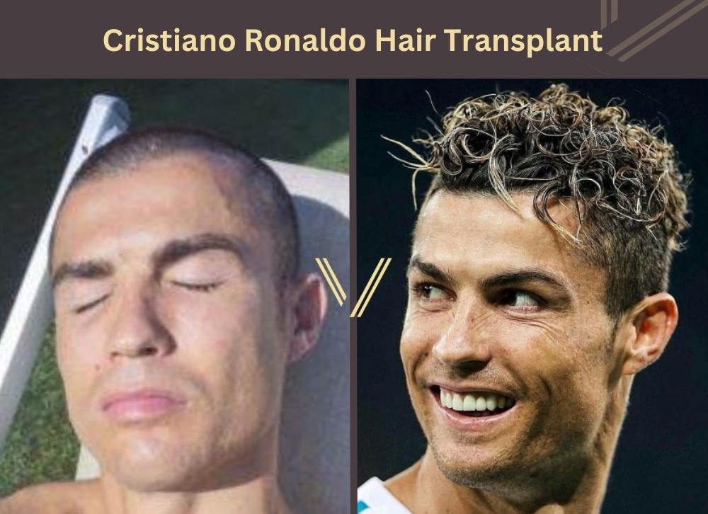 ronaldo hair transplant before after