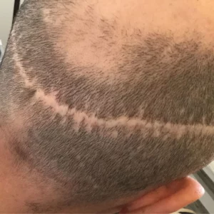 scar hair transplant