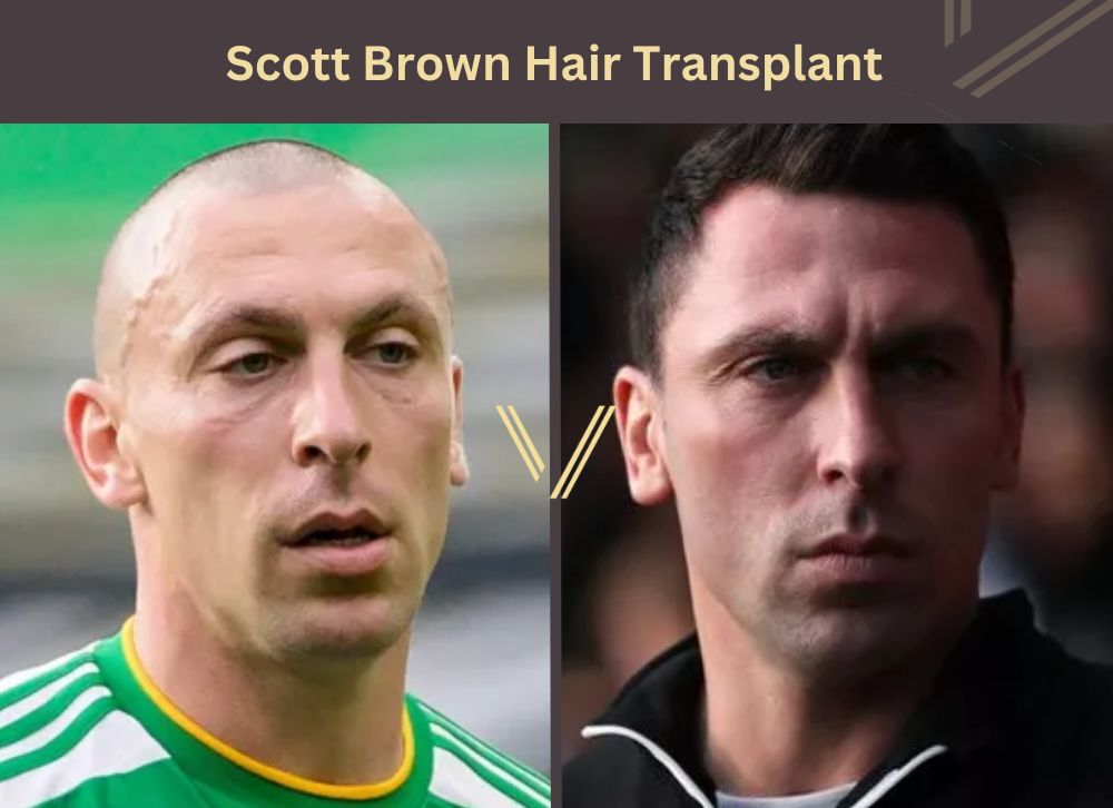 scott brown hair transplant before after