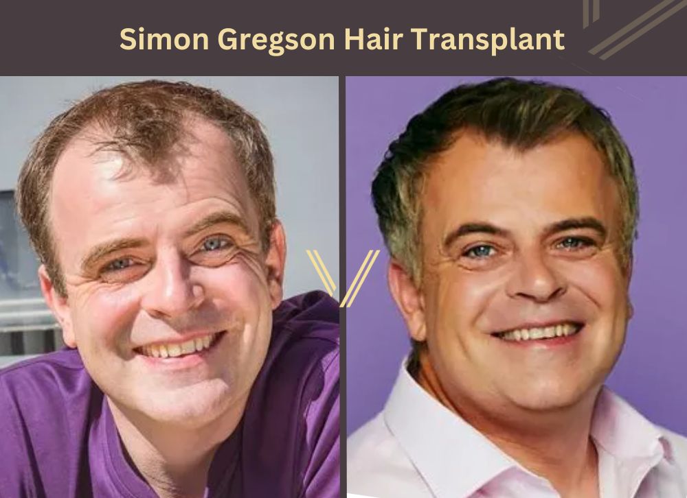 simon gregson hair transplant before after