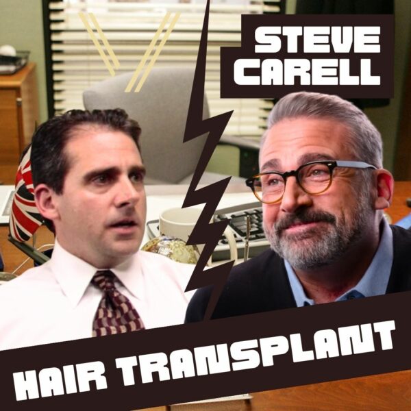 steve carell hair transplant