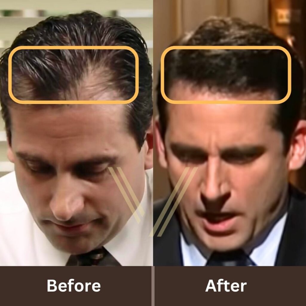 Steve Carell's Hair Transplant: Before and After Transformation