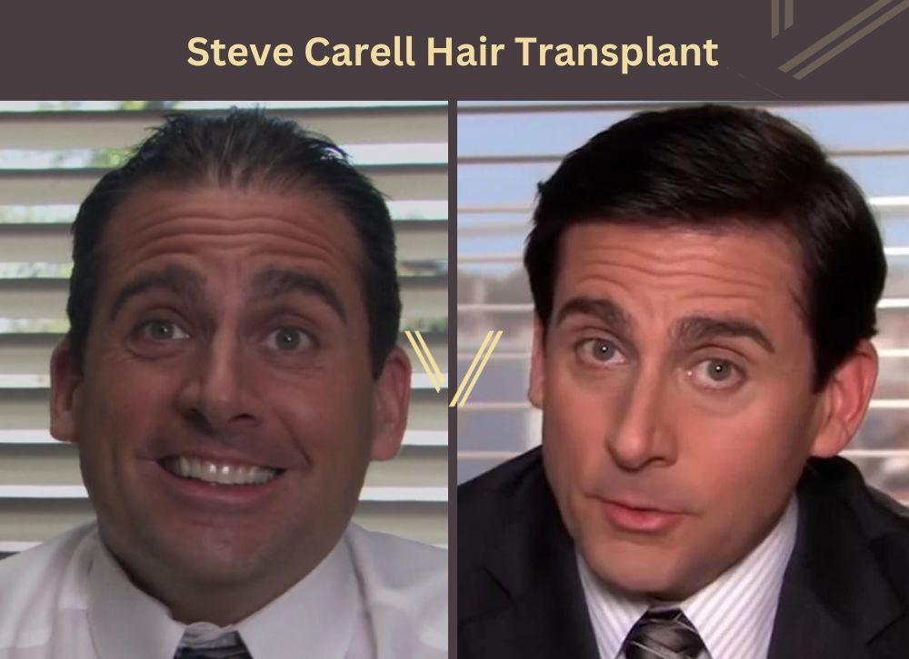 steve carell hair transplant before after
