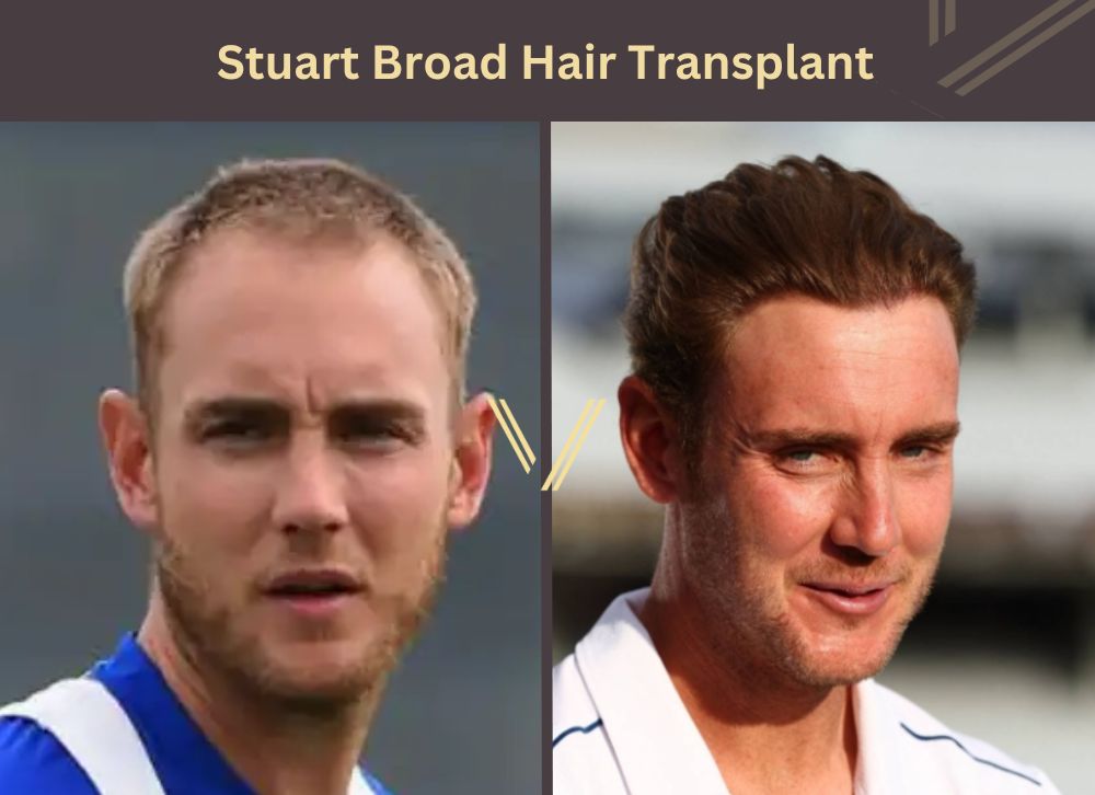 stuart broad hair transplant before after