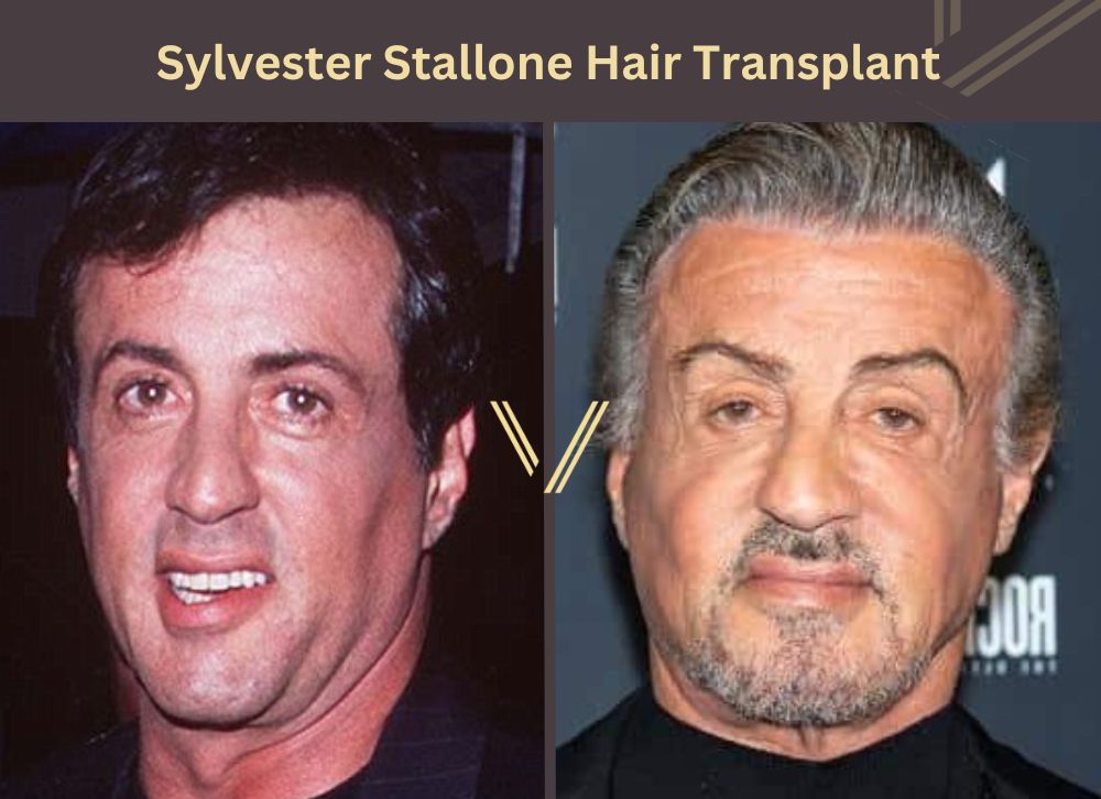 sylvester stallone hair transplant before after