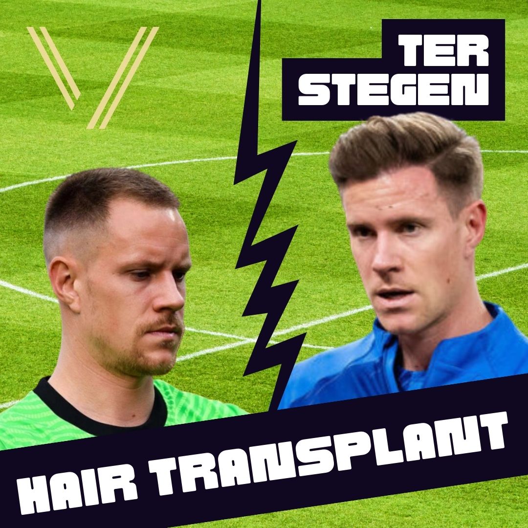 Ter Stegen's Hair Transplant: Before and After Transformation