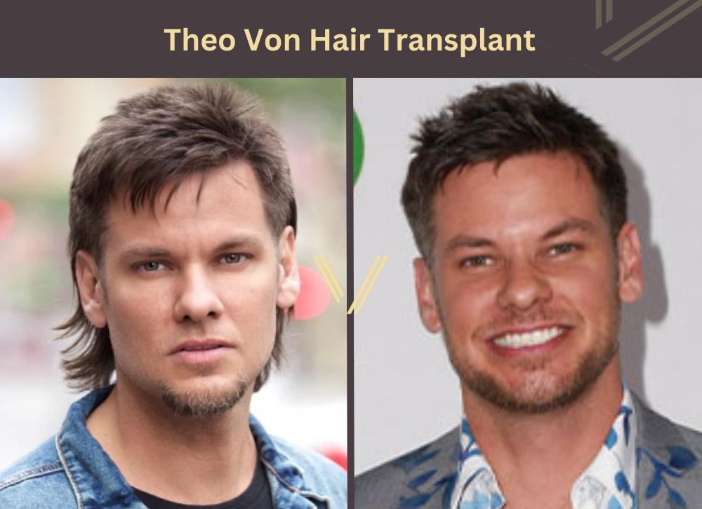 theo von hair transplant before after