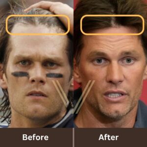 tom brady hair transplant before after 