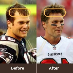 tom brady hair transplant before after result