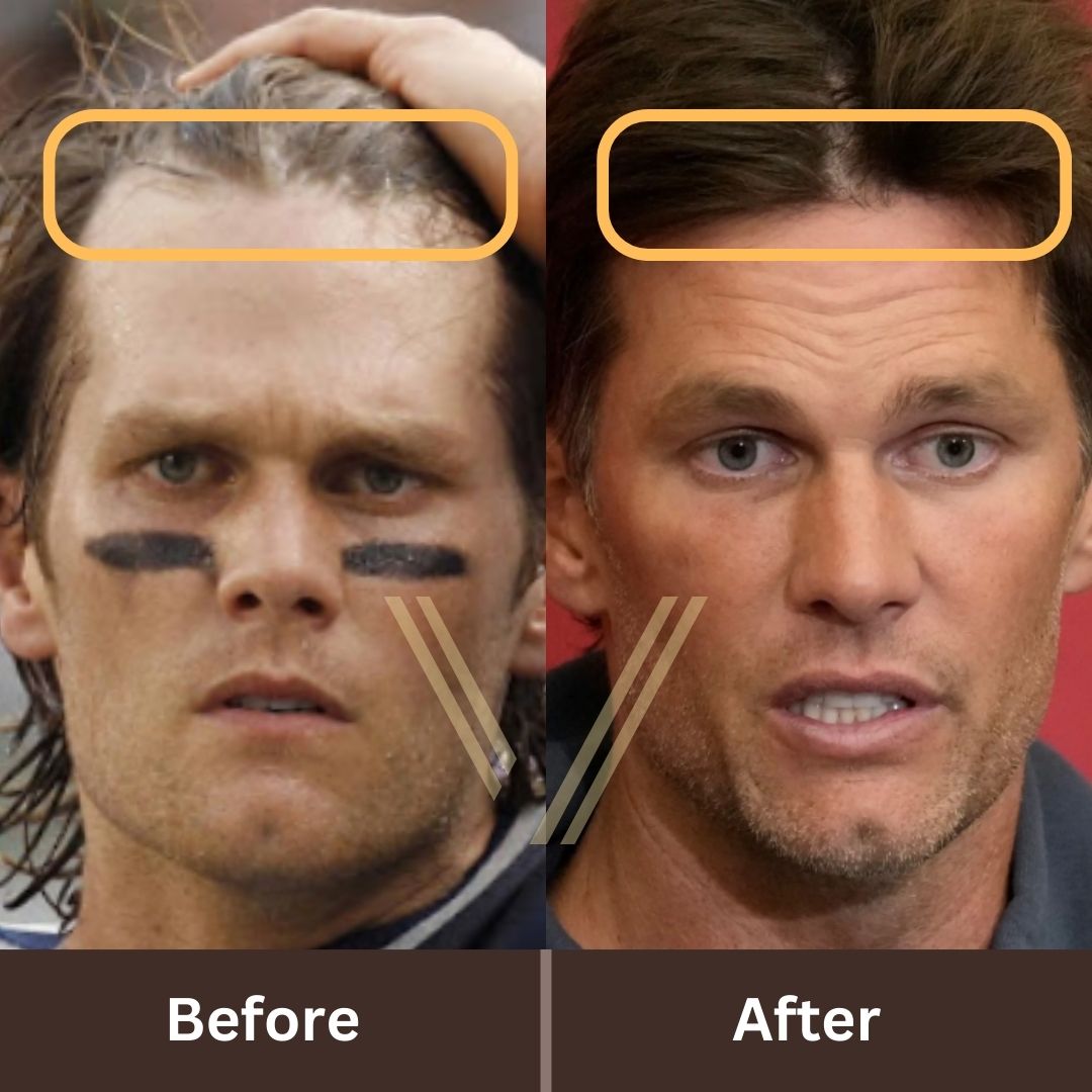 Tom Brady Hair Transplant: Before and After Transformation